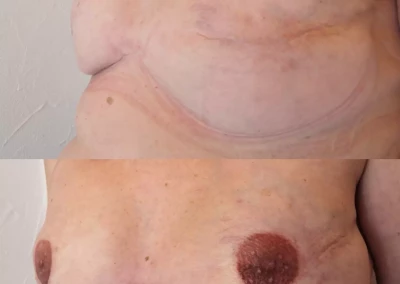dermographie reparatrice areoles mammaires