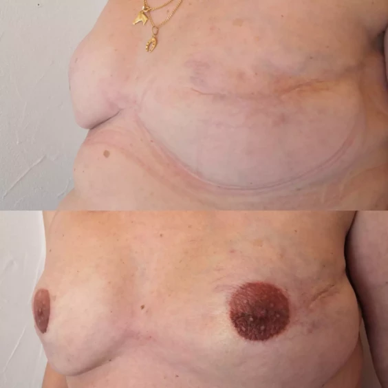 dermographie reparatrice areoles mammaires